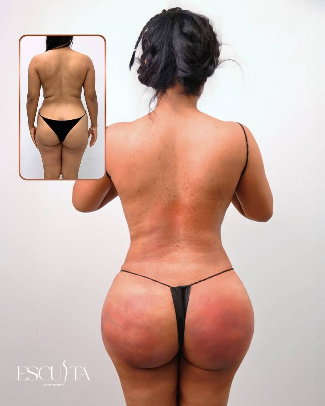 BBL and liposuction before and after at Esculta Aesthetics