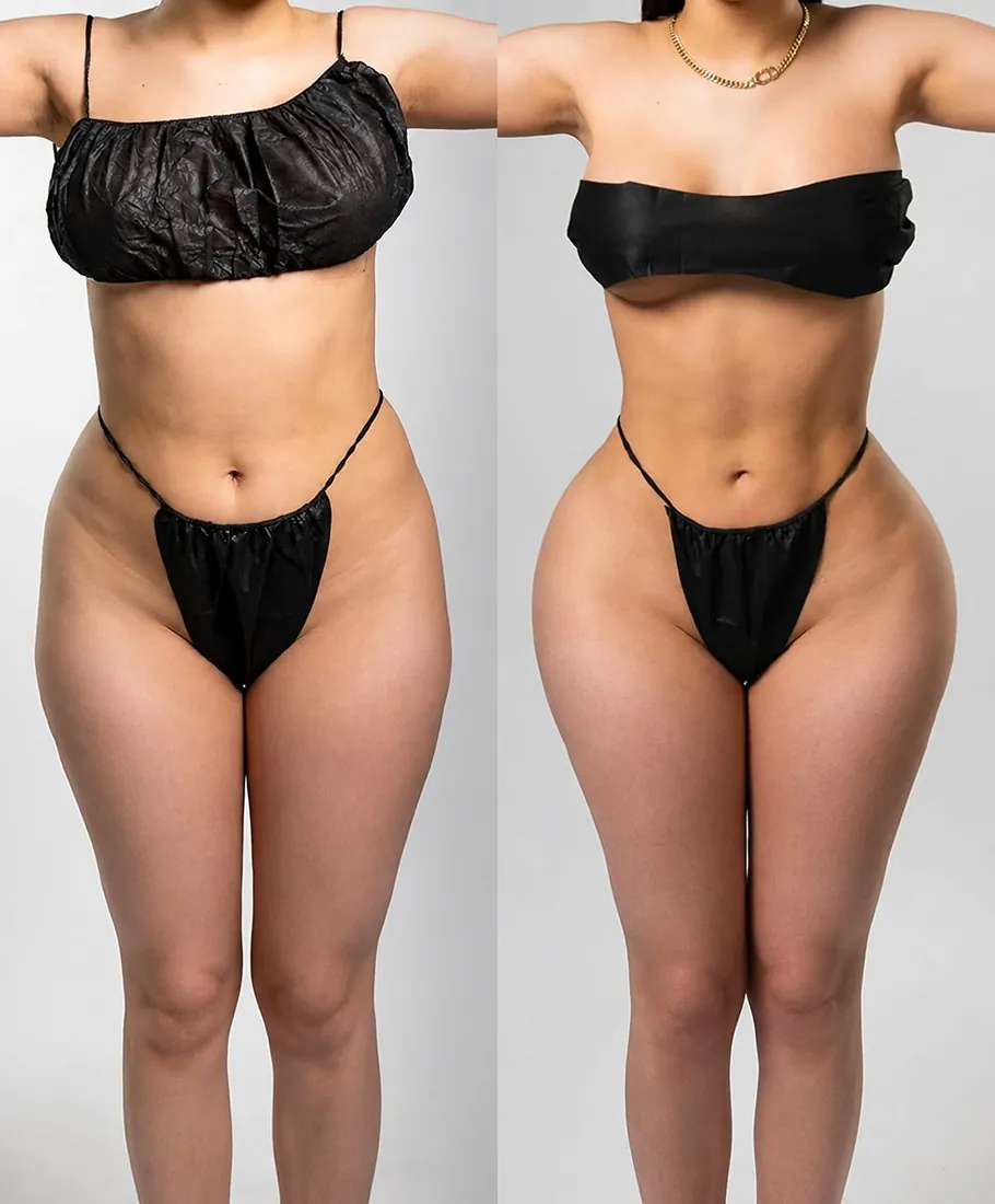 Lipo 360 result, front view, at Esculta Aesthetics Miami