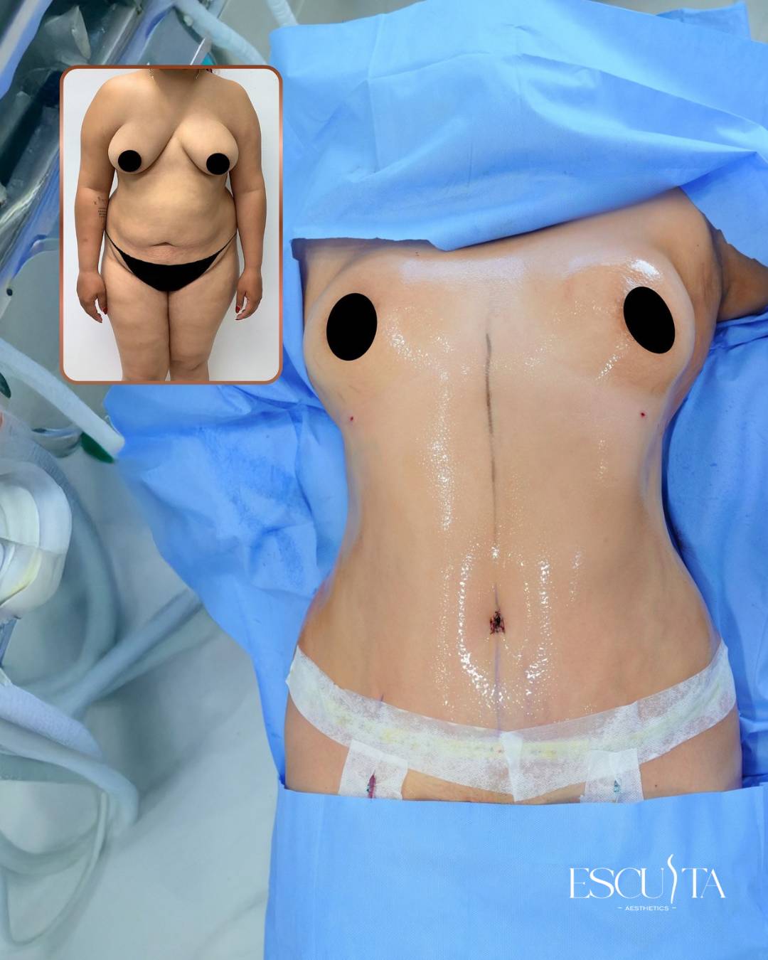 Tummy tuck and liposuction before and after at Esculta Aesthetics